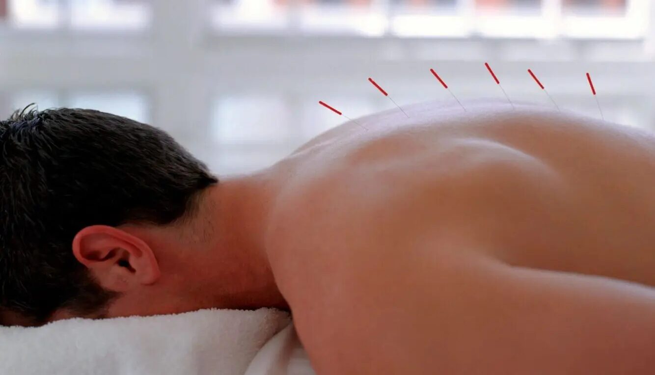 Motor Point Acupuncture in San Francisco