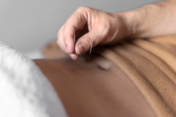 Fertility Acupuncture