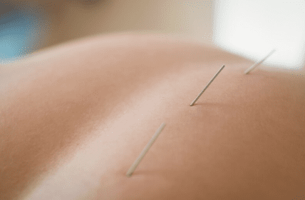 5 Natural Ways to Enhance Your Acupuncture Results
