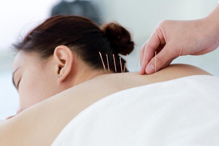The Benefits of Acupuncture for Treating Chronic Pain The Benefits of Acupuncture for Treating Chronic Pain