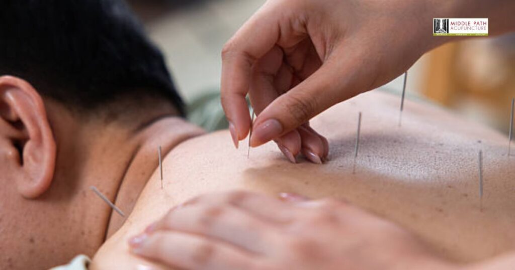 Acupuncture to Treat Back Pain: Complete Care Guide