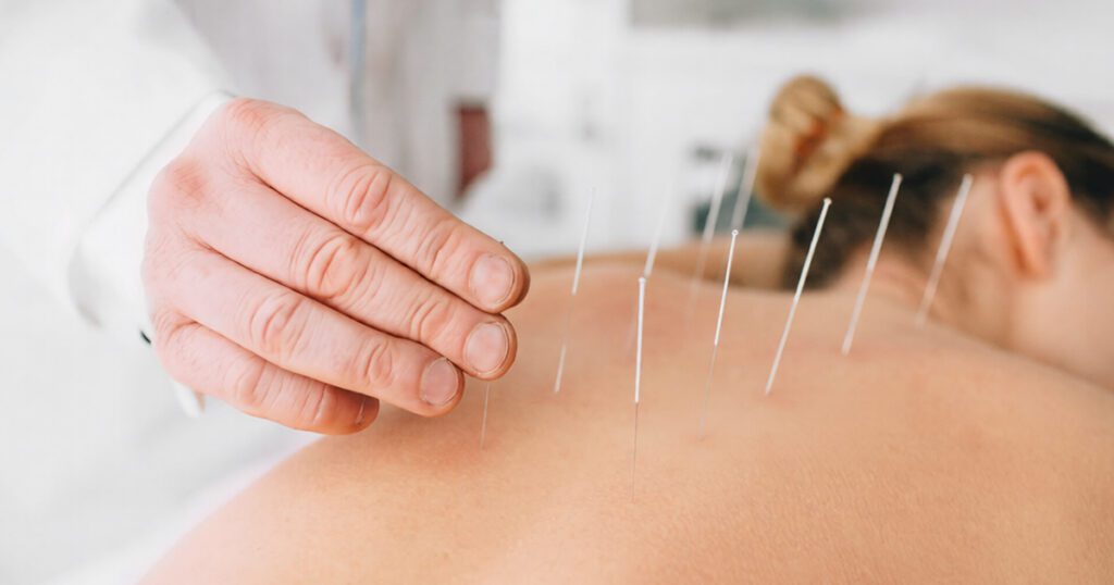 acupuncture for stress relief