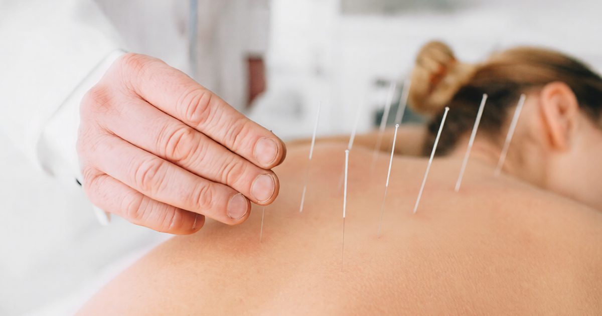 acupuncture for stress relief