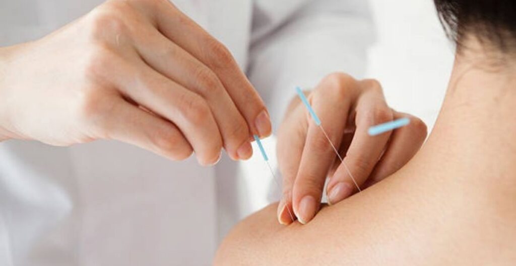 acupuncture treatment in san francisco
