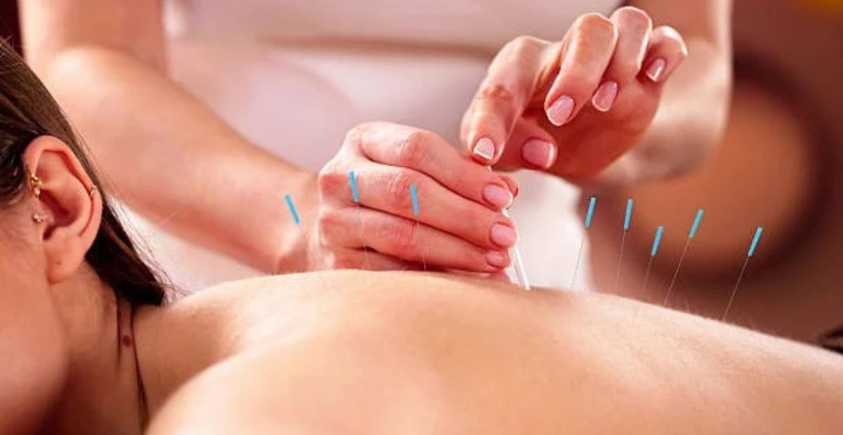 dry needling in california