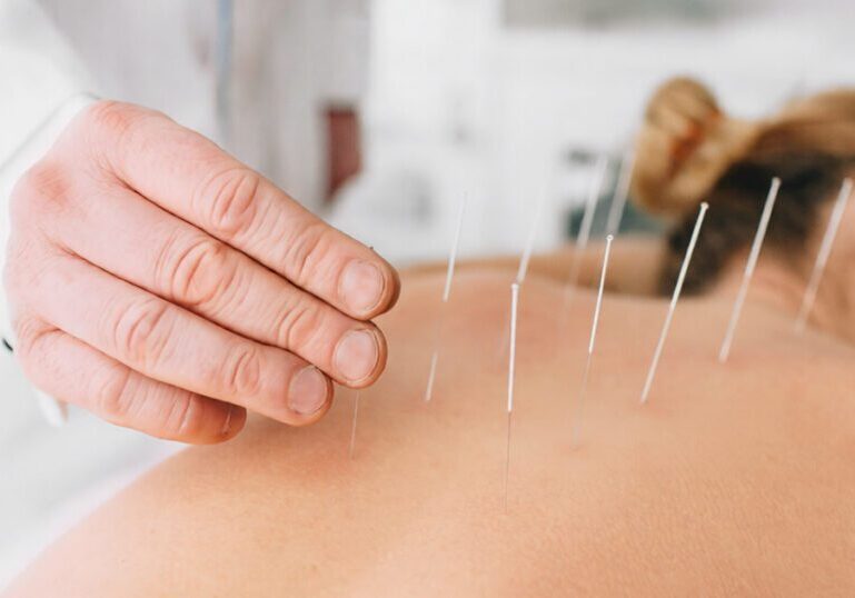 acupuncture for stress relief