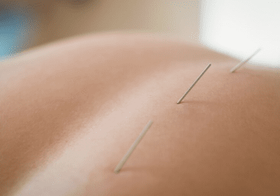 5 Natural Ways to Enhance Your Acupuncture Results