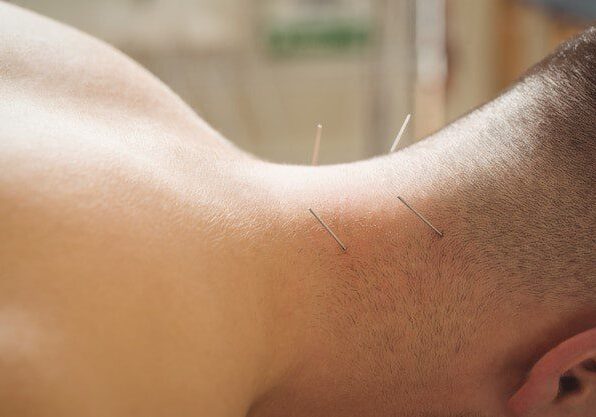 Acupuncture For Neck Pain