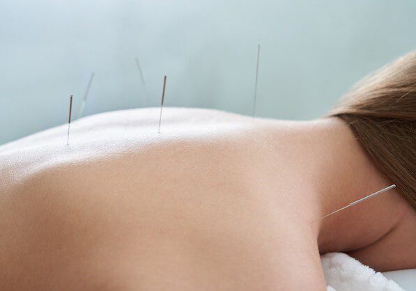 Benefits of Acupuncture in Pain Management