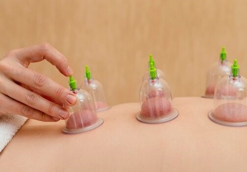 Cupping Treatment
