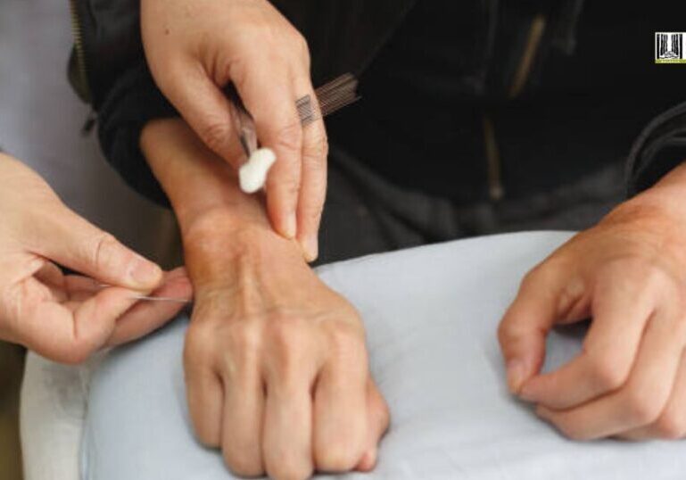 Boost Your Immune System with Regular Acupuncture Sessions