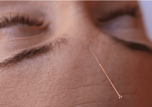 Can Acupuncture Reduce Anxiety?
