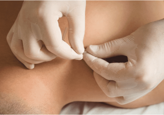 The Benefits of Trigger Point Dry Needling