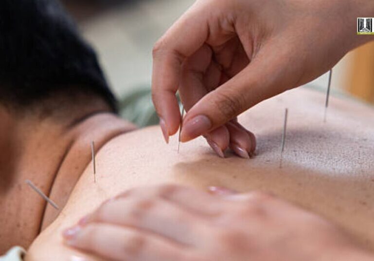 Acupuncture to Treat Back Pain: Complete Care Guide