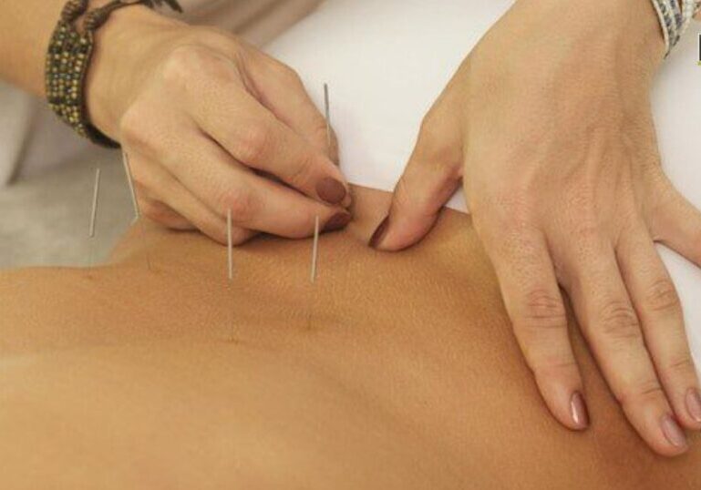 acupuncture treatment for low back pain