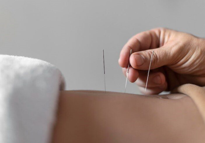 Acupuncture