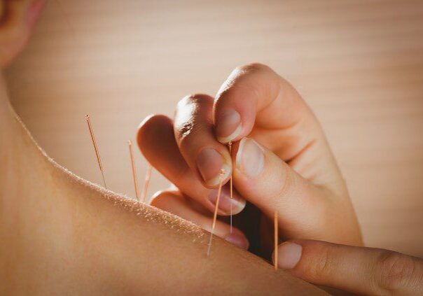 Motor Point Acupuncture